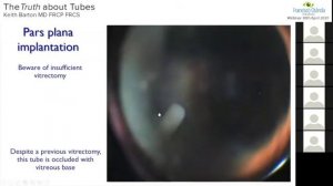 The Truth about Tubes. Keith Barton MD FRCS FRCP. Webinar 30/04/2020.