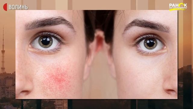 Рецепти краси Розацеа смотреть онлайн