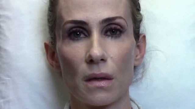 Dermal Fillers for Temples ~ Temple Restoration with Amazing Results! смотреть онлайн