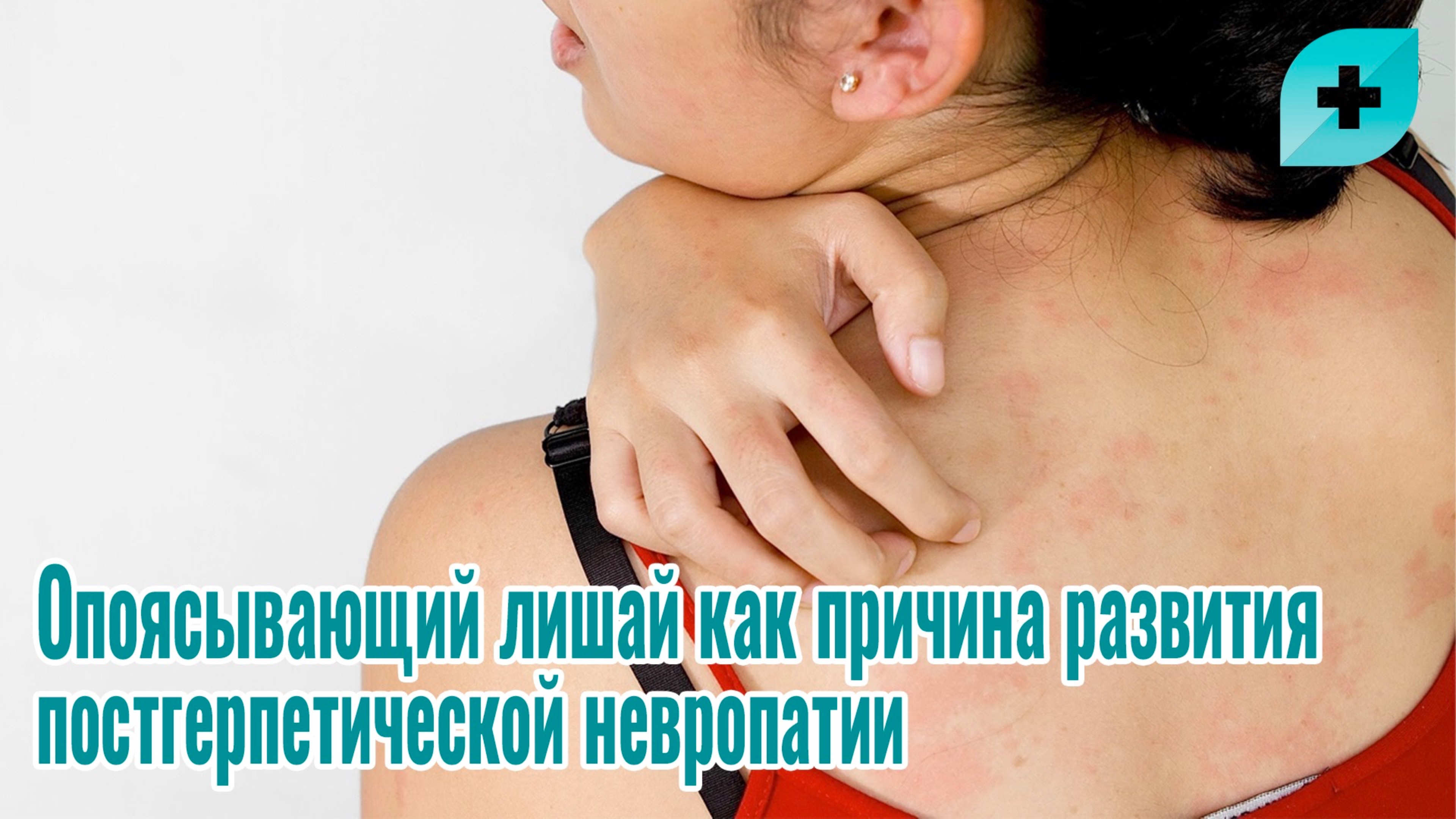 Опоясывающий лишай как причина развития постгерпетической невропатии