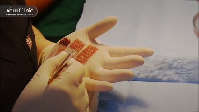 Zografos from Greece talks about his experience with Vera Clinic for hair transplantation in Turkey