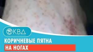 Коричневые пятна на ногах. Клинический случай №45