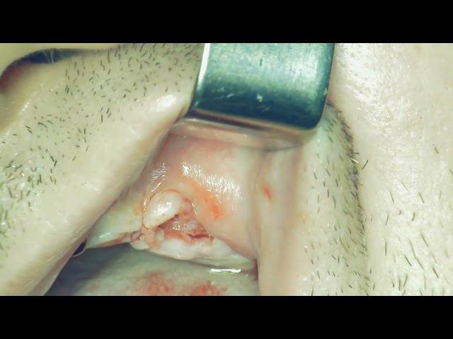 Implantation  of missing tooth 24. Implant system ICX-Active.