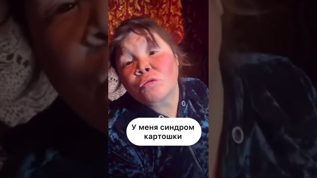 Синдром картошки