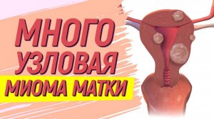 Многоузловая миома матки. Удалить нельзя лечить.