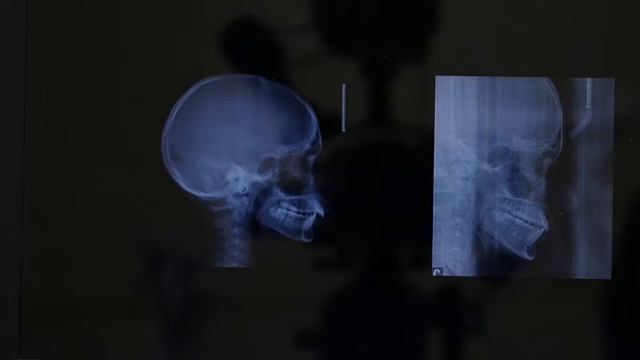 Смещение нижней челюсти, неправильный прикус