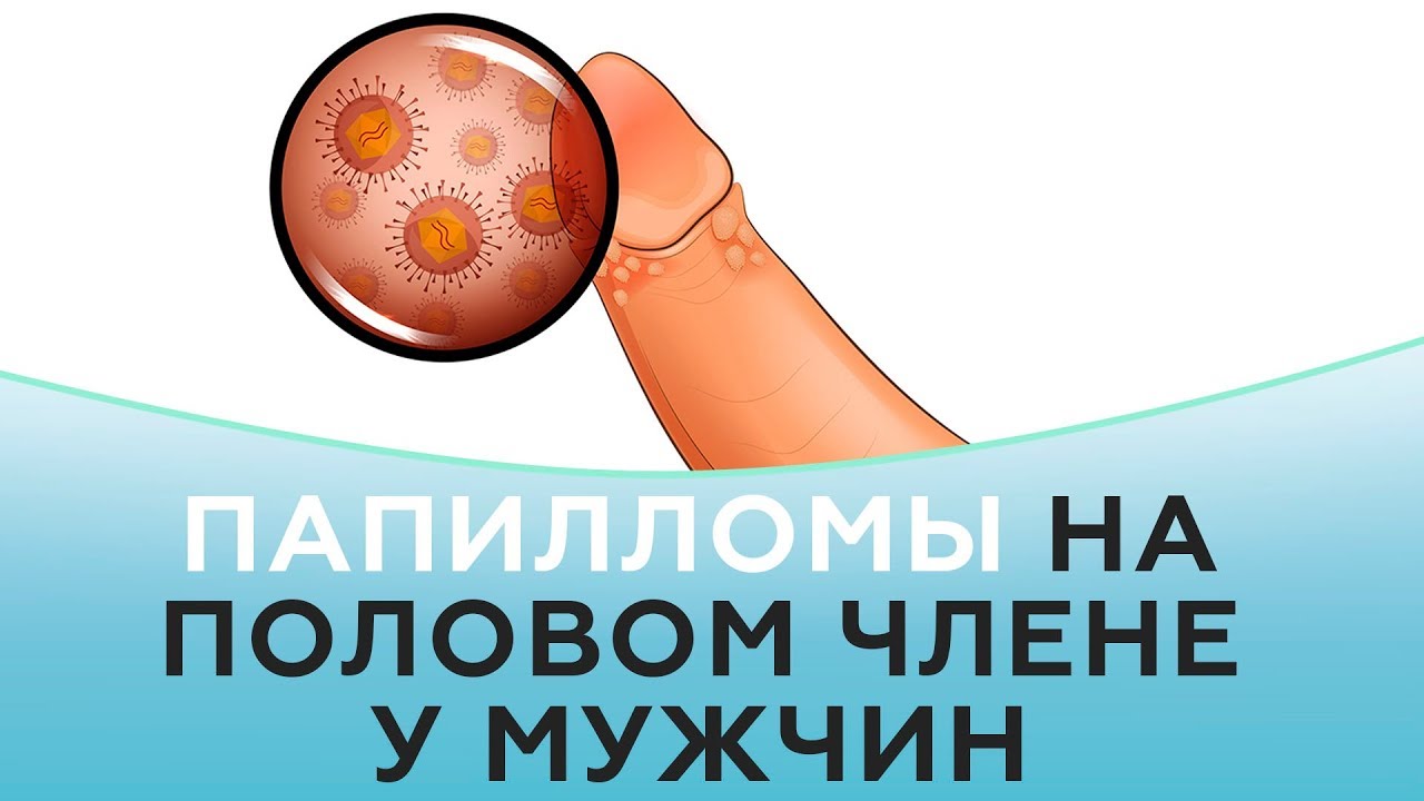 Папилломы на половом члене у мужчин
