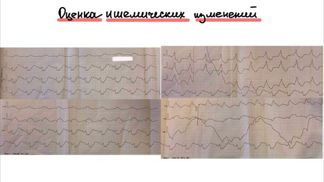 Разбор ЭКГ от подписчика. Пациент в критическом состоянии. (Острый коронарный синдром)