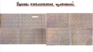 Разбор ЭКГ от подписчика. Пациент в критическом состоянии. (Острый коронарный синдром)