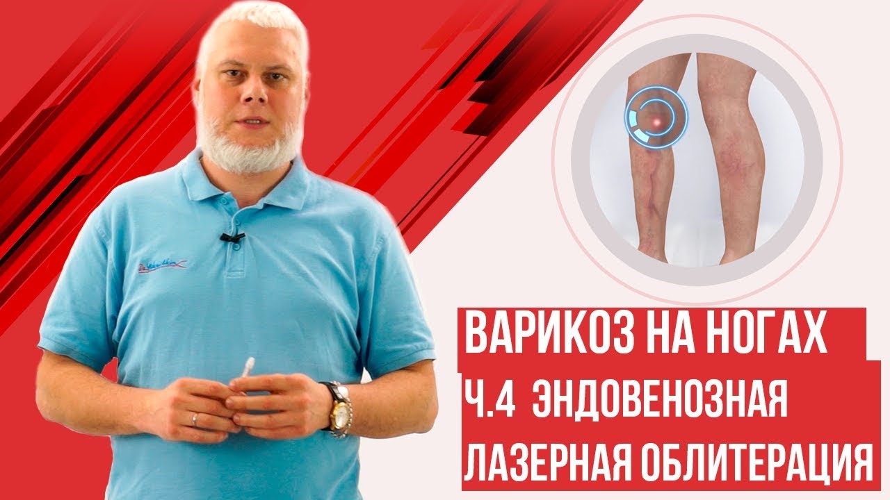 Эндовенозная лазерная облитерация. Варикоз на ногах 2ч.