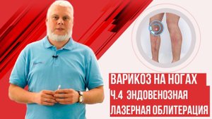 Эндовенозная лазерная облитерация. Варикоз на ногах 2ч.