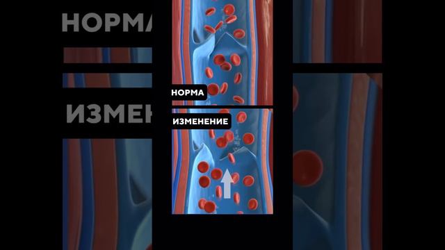 Как избавиться от варикоза?