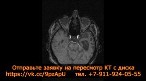 Аномалия Киммерли и вероятность тромбоза при расшифровке КТ ангиографии артерий и вен