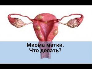 Миома матки. Что делать?