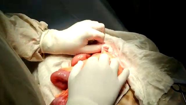 Irreducible ventral hernia. Невправима вентральна грижа. смотреть онлайн