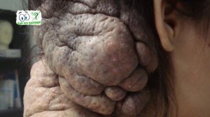 Невусы - виды невусов, причины и лечение