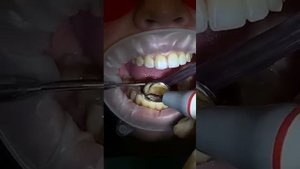 Как проходит профессиональная гигиена зубов?