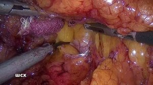 Лапароскопическая резекция желудка