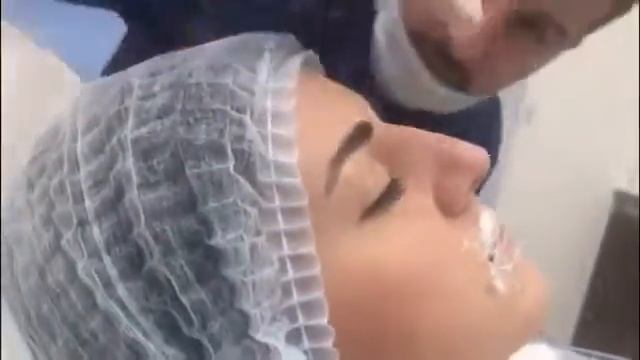 Контурная пластика носа. Прямое включение!