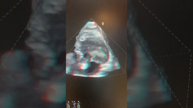 3D Stress Echo смотреть онлайн