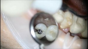 Удаление сломанного фиксирующего винта импланта. Implant screw removing