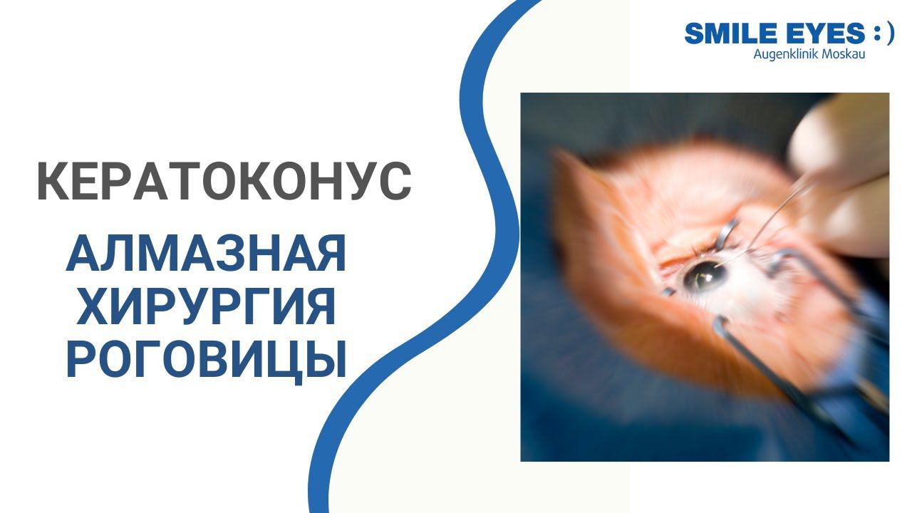 Лечение кератоконуса и алмазная хирургия роговицы - мнение профессора Секундо