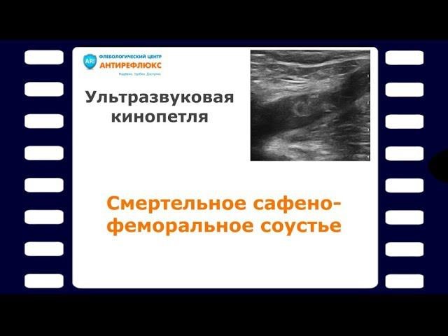 Смертельное сафено-феморальное соустье