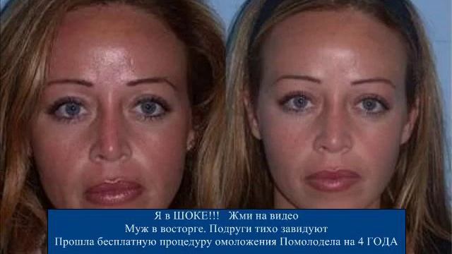 Пилинг С Хлоридом Кальция [Хлористый Пилинг]