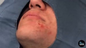SATISFYING! Dr Lee Pops Inflamed Cyst on Chin | Dr Pimple Popper Reacts
