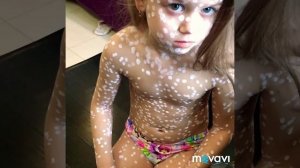 Девочка -аватар или ветрянка