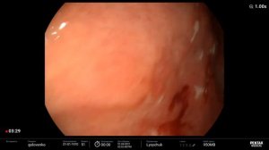 Stomach cancer/ Инфильтративный рак желудка