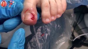 Вросший ноготь и гной под ногтем / Горький опыт обращения к хирургу