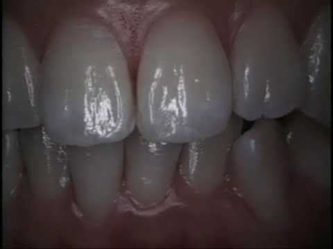 металлокерамика 1 часть для зубных техников смотреть онлайн