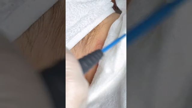 Удаление папилломы на шее смотреть онлайн