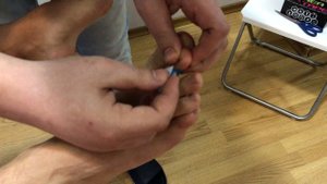Наложение кинезио тейпа при молоткообразном пальце