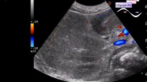 Детское УЗИ желудка - Гипертрофический пилоростеноз