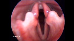 Паралич гортани. Laryngeal paralysis