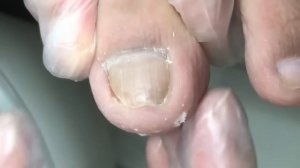 Simple repair of ingrown nails on both sides!【Crazy pedicure room】