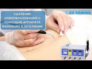 Удаление новообразований с помощью аппарата RADIOSURG в ОН КЛИНИК