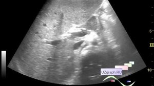 Детское УЗИ брюшной полости - Спонтанное контрастирование воротной вены (мононуклеоз)