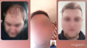 ПЕРЕСАДКА ВОЛОС / СВЕТЛЫЕ ВОЛОСЫ / КАКОЙ ОЖИДАТЬ РЕЗУЛЬТАТ???