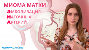 Удаление миомы матки методом ЭМА - эмболизация маточных артерий | Mednavigator.ru