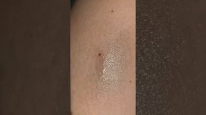 Как вытащить клеща на даче