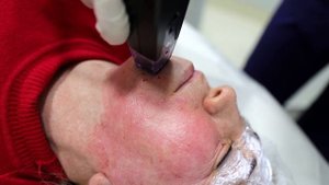 RF-лифтинг Morpheus/ Аппаратная подтяжка лица/