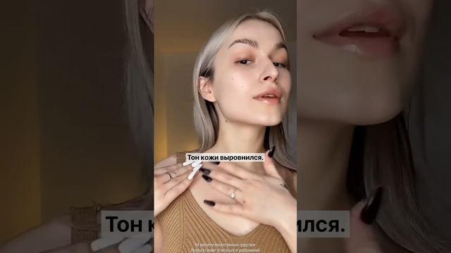 Избавилась от прыщей на щеках и зоне декольте