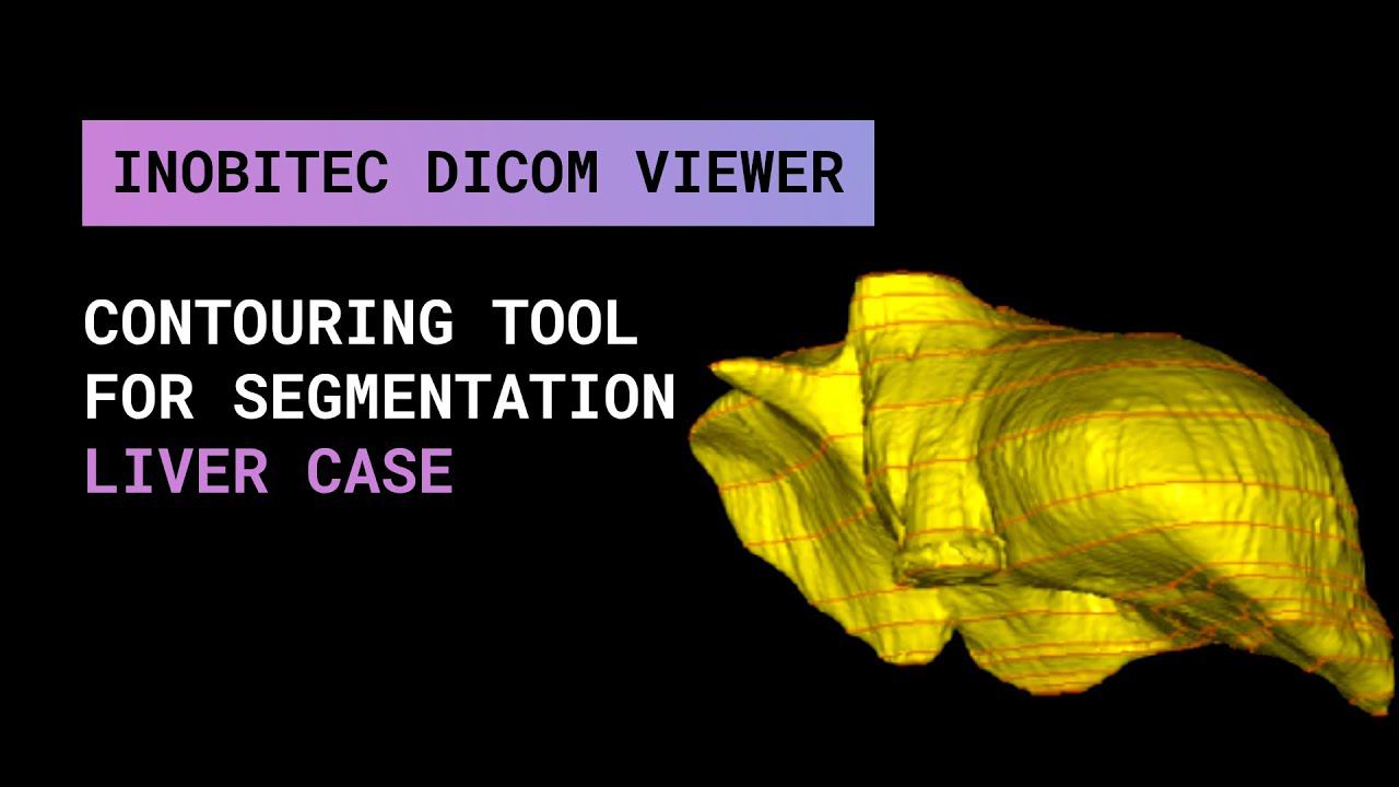 Инструмент оконтуривания для сегментации в Inobitec DICOM Viewer Pro на примере печени.