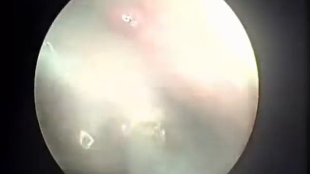 Применение диодного лазера CERALAS D50 (длина волны 980 нм) (видеоролик) смотреть онлайн