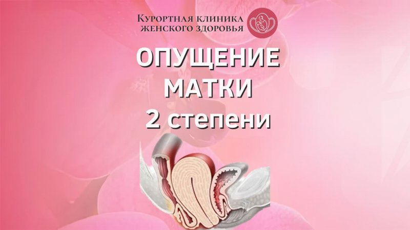 Опущение матки 2 степени