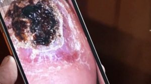 Елена Дзык хвастается результатом удаления гранулемы