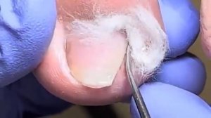 Ingrown nails lead to paronychia, need regular trimming to recover【Doctor Liu Pedicure】